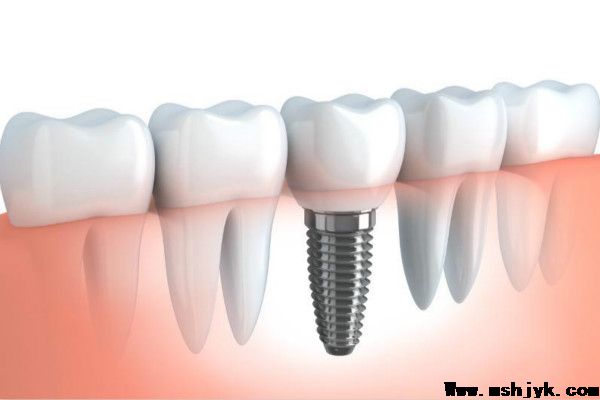 种植牙是不是可以用一辈子？
